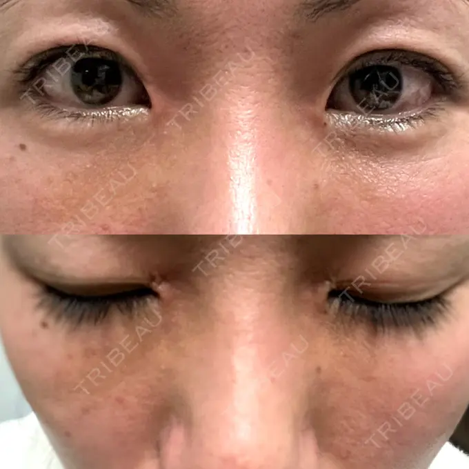 下まぶたたるみ取り セオリークリニック DAY 7 メイン用