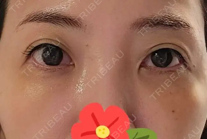 クマ治療 / 下まぶたたるみ取り / その他（目元） セオリークリニック DAY 10 メイン用