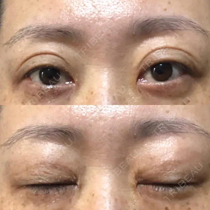 二重埋没 / 目元修正 新宿TAクリニック DAY 64 メイン用