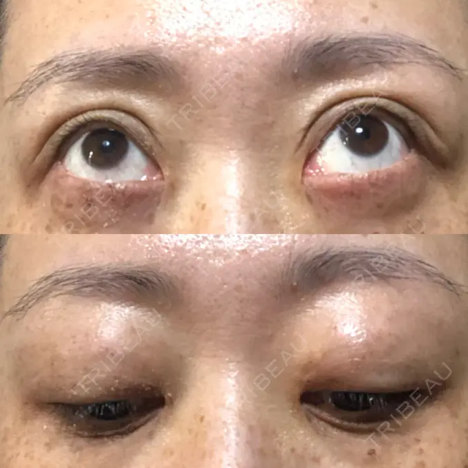 二重埋没 / 目元修正 新宿TAクリニック DAY 64 メイン用