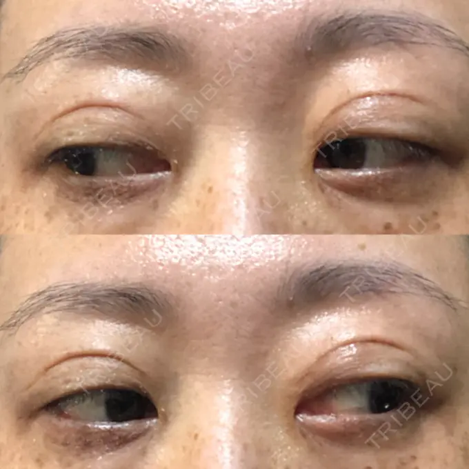 二重埋没 / 目元修正 新宿TAクリニック DAY 64 メイン用