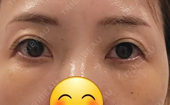 クマ治療 / 下まぶたたるみ取り / その他（目元） セオリークリニック DAY 11 メイン用