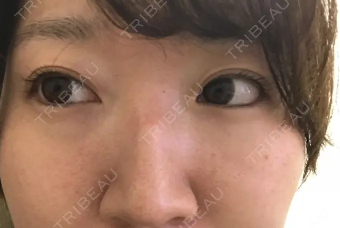 美肌レーザー / シミ取りレーザー / ルビーレーザー 銀座お肌の診療所 DAY 7 メイン用