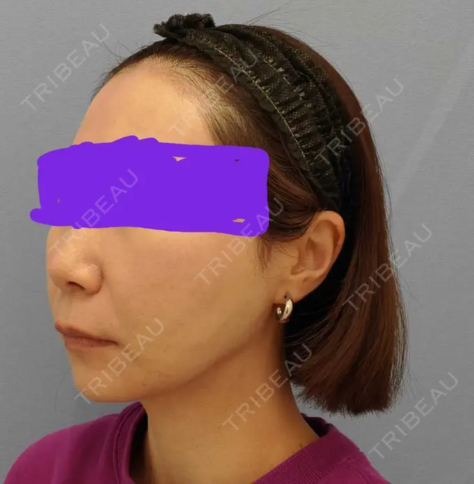 糸リフト / 脂肪吸引（顔） / メーラーファット除去 湘南美容クリニック 秋葉原院 DAY 108 メイン用