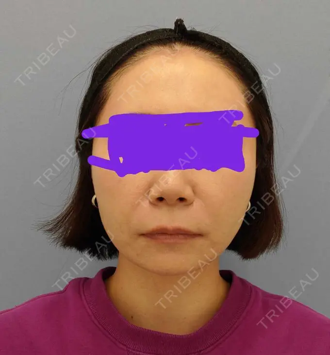 糸リフト / 脂肪吸引（顔） / メーラーファット除去 湘南美容クリニック 秋葉原院 AFTER メイン用