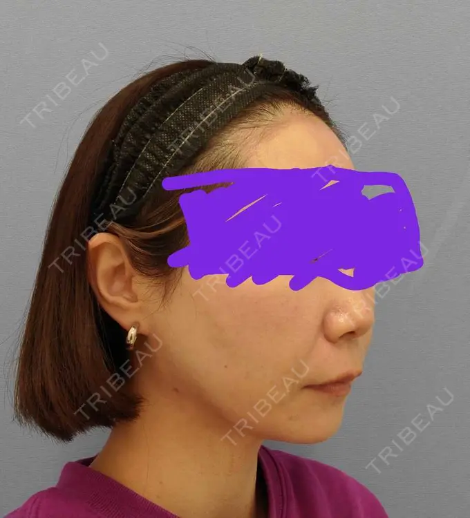 糸リフト / 脂肪吸引（顔） / メーラーファット除去 湘南美容クリニック 秋葉原院 DAY 108 メイン用