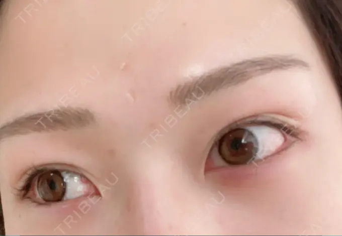 ヒアルロン酸注入（涙袋） / ボトックス（眉間） TCB東京中央美容外科 宇都宮院 DAY 11 メイン用