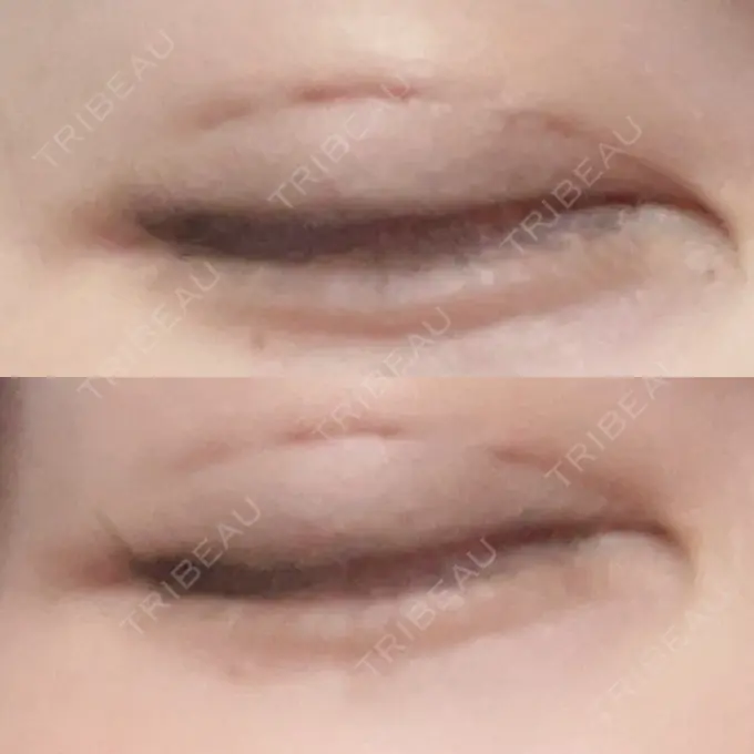 二重埋没 よだ形成外科クリニック DAY 10 メイン用