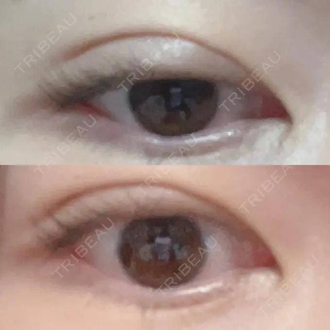 二重埋没 よだ形成外科クリニック DAY 10 メイン用