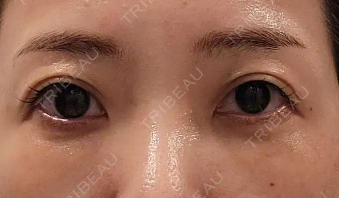 クマ治療 / 下まぶたたるみ取り / その他（目元） セオリークリニック DAY 14 メイン用