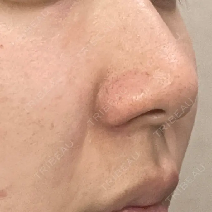 鼻孔縁挙上 シエルクリニック DAY 45 メイン用