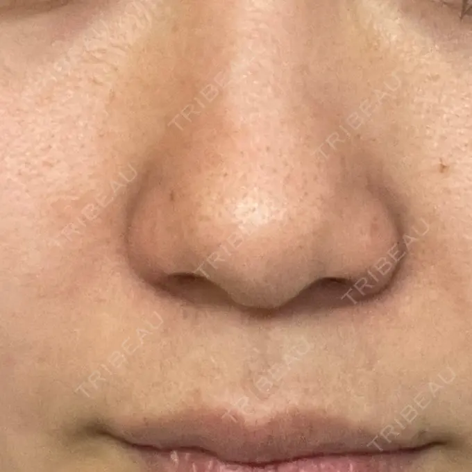 鼻孔縁挙上 シエルクリニック DAY 45 メイン用