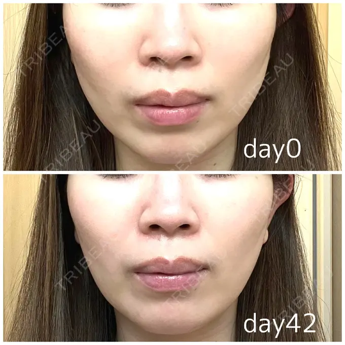 ボトックス（エラ・小顔） LIBER CLINIC AFTER メイン用