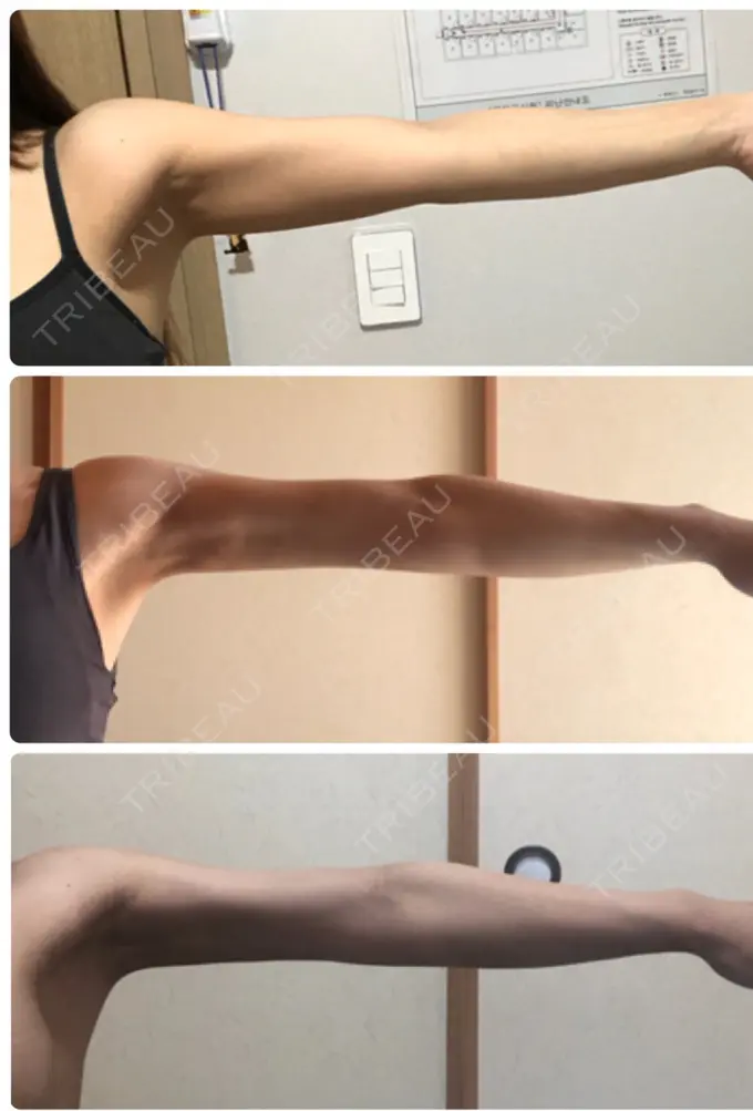 脂肪吸引（二の腕） ヨンセスリムライン AFTER メイン用