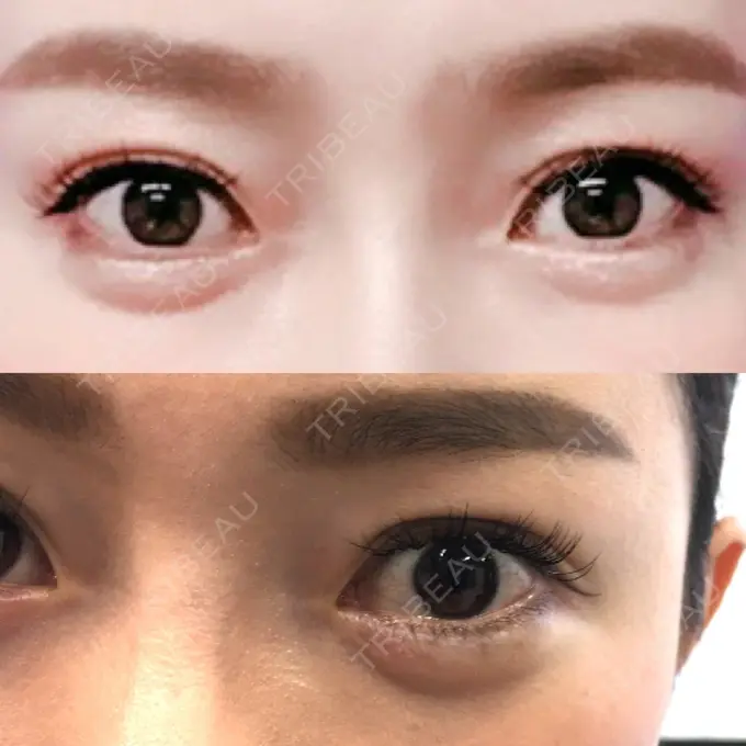 ヒアルロン酸注入（涙袋） TCB東京中央美容外科 中野院 AFTER メイン用