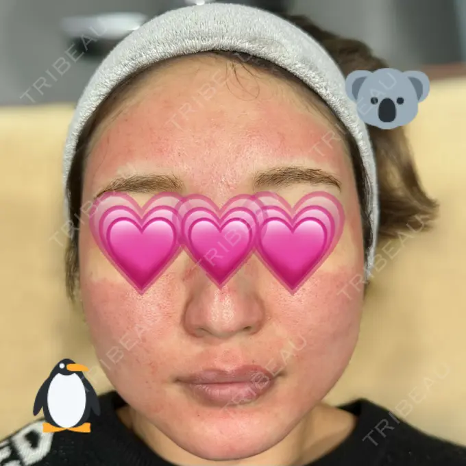 ダーマペン 聖心美容クリニック 大宮院 DAY 0 メイン用