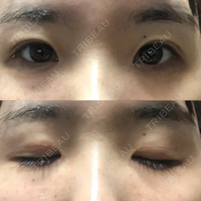二重埋没 / 眼瞼下垂（非切開） WOM CLINIC GINZA （ワム クリニック ギンザ） AFTER メイン用
