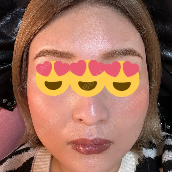 ダーマペン 聖心美容クリニック 大宮院 DAY 2 メイン用