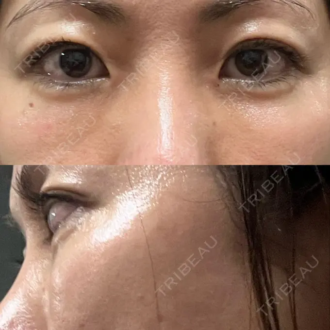 下まぶたたるみ取り セオリークリニック DAY 14 メイン用