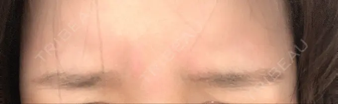 ボトックス（眉間） TCB東京中央美容外科 中野院 DAY 1 メイン用