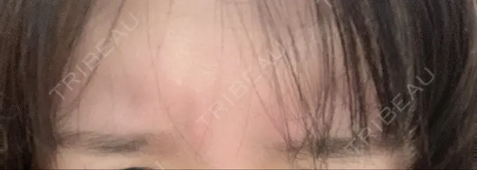 ボトックス（眉間） TCB東京中央美容外科 中野院 DAY 2 メイン用