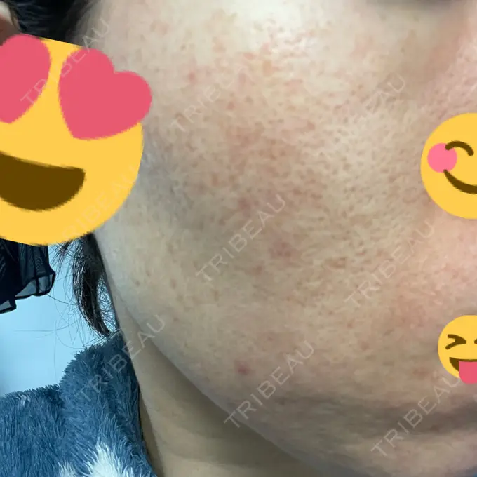 イオン導入 / ニードルRF（ポテンツァなど） オラクル美容皮膚科 名古屋院 DAY 1 メイン用