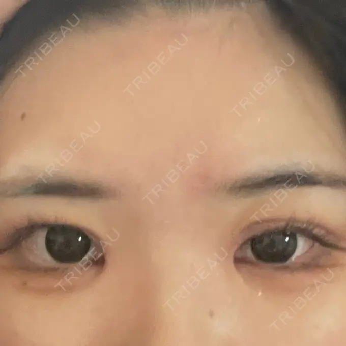 目頭切開 聖心美容クリニック 名古屋院 DAY 7 メイン用