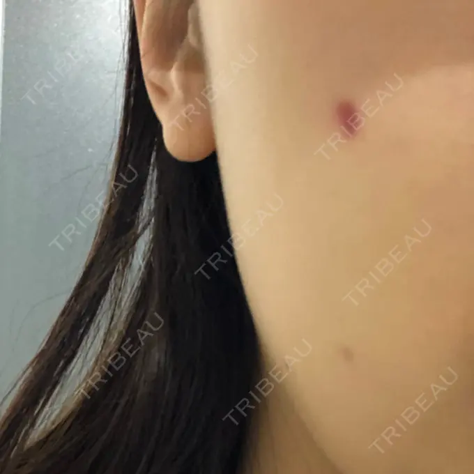 ほくろ・いぼ切除（肌） 吉祥寺アイビークリニック DAY 88 メイン用