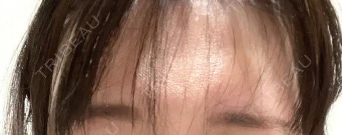 ボトックス（眉間） TCB東京中央美容外科 中野院 DAY 4 メイン用