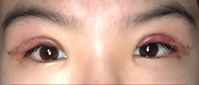 二重切開 / 上まぶたの脂肪取り ブリスクリニック形成外科・美容外科・美容皮膚科 福岡 DAY 2 メイン用