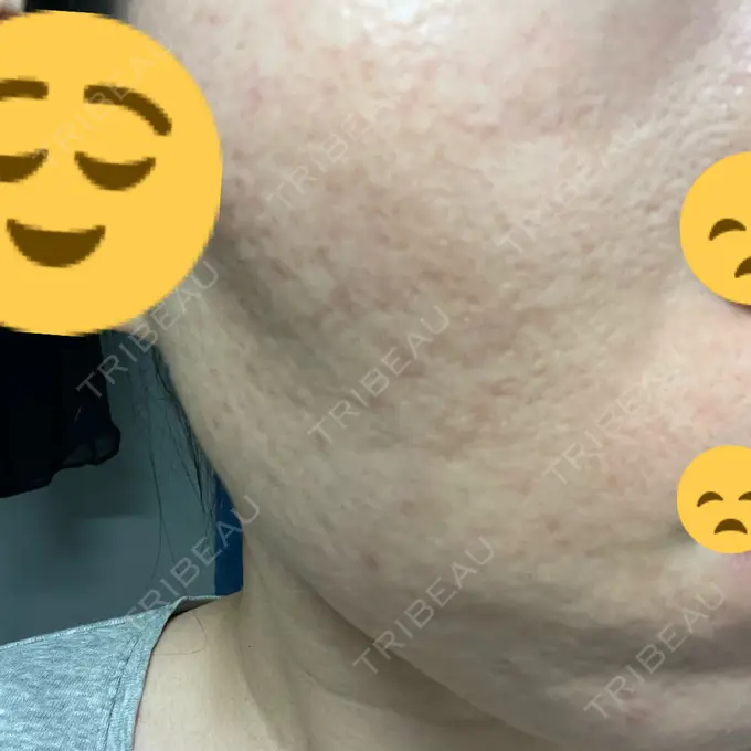 イオン導入 / ニードルRF（ポテンツァなど） オラクル美容皮膚科 名古屋院 DAY 3 メイン用