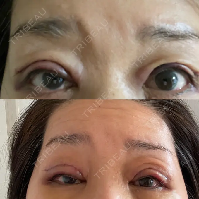 二重切開 / 眼瞼下垂（切開） / 上まぶたたるみ取り X CLINIC 大阪院 AFTER メイン用
