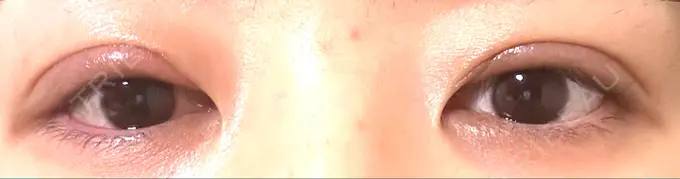 眼瞼下垂（切開） / 目元修正 札幌ル・トロワ ビューティクリニックVogue DAY 42 メイン用