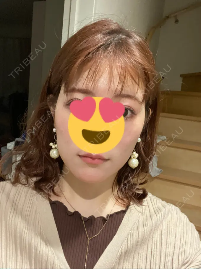 フォトRF リアルクリニック（REAL CLINIC） AFTER メイン用