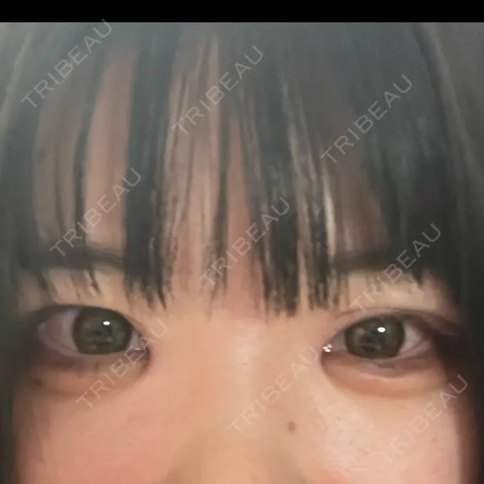 目頭切開 聖心美容クリニック 名古屋院 DAY 9 メイン用