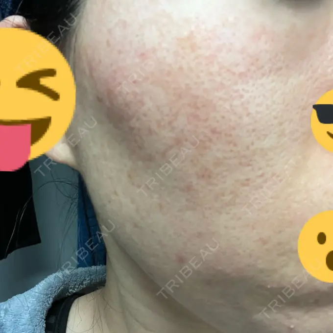 イオン導入 / ニードルRF（ポテンツァなど） オラクル美容皮膚科 名古屋院 DAY 4 メイン用