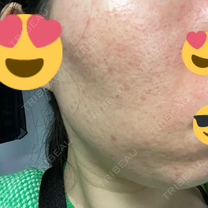 イオン導入 / ニードルRF（ポテンツァなど） オラクル美容皮膚科 名古屋院 DAY 5 メイン用