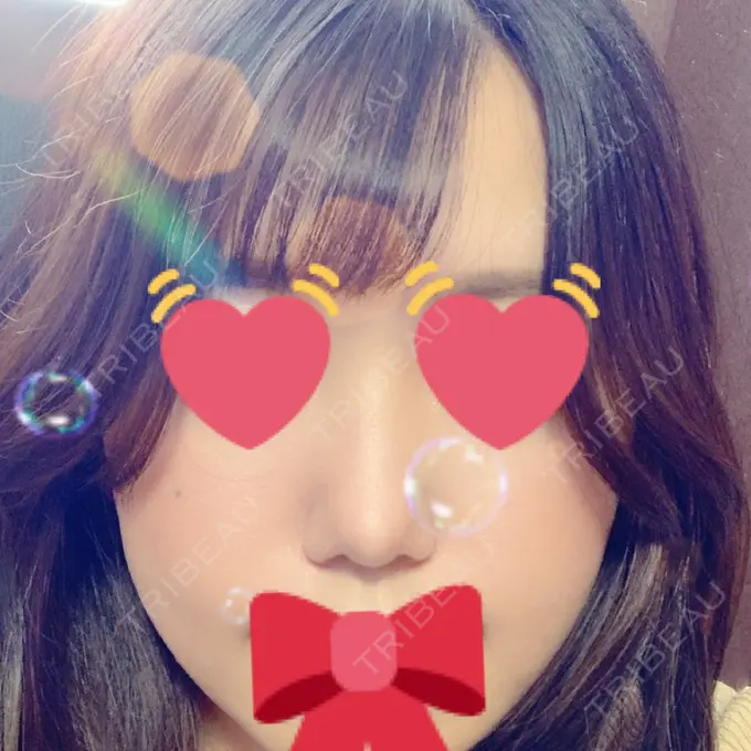 鼻尖形成（切開） / ヒアルロン酸注入（鼻） / その他（鼻） 高崎TAクリニック AFTER メイン用