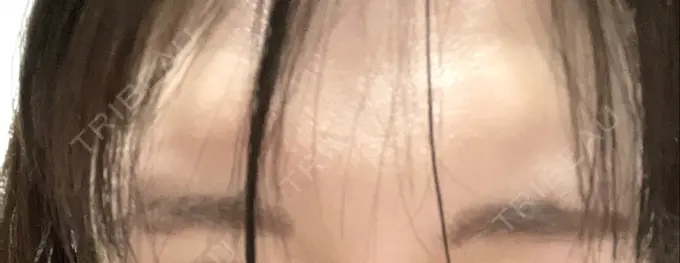 ボトックス（眉間） TCB東京中央美容外科 中野院 DAY 7 メイン用