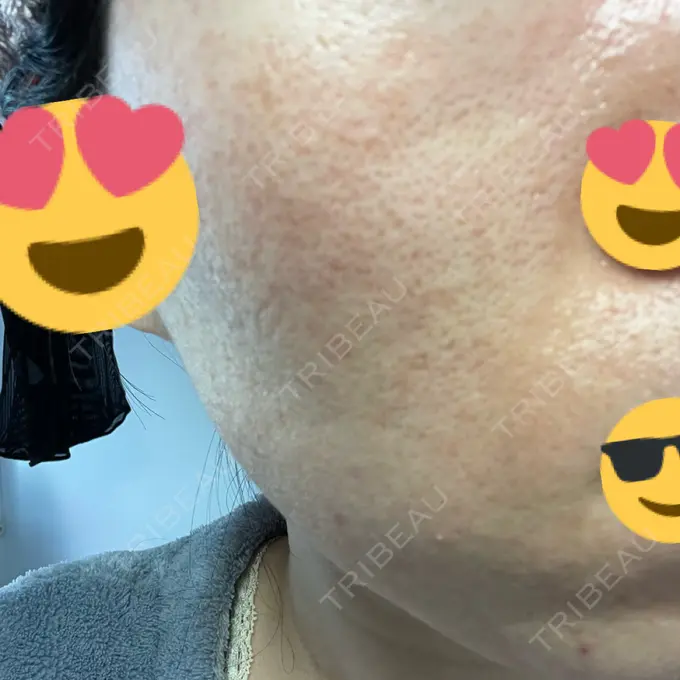 イオン導入 / ニードルRF（ポテンツァなど） オラクル美容皮膚科 名古屋院 DAY 6 メイン用