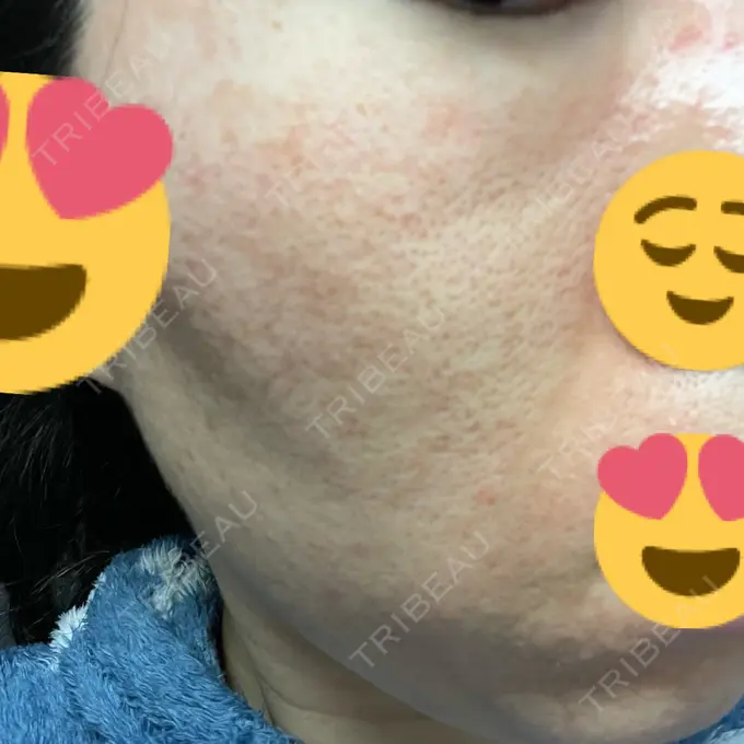 イオン導入 / ニードルRF（ポテンツァなど） オラクル美容皮膚科 名古屋院 DAY 7 メイン用