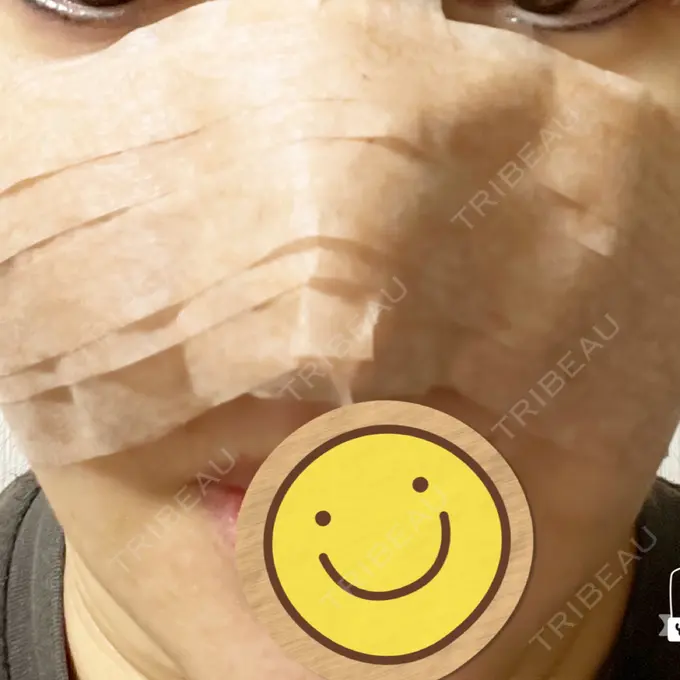 鼻尖形成（切開） / ワシ鼻修正・ハンプ切除 みずほクリニック DAY 0 メイン用