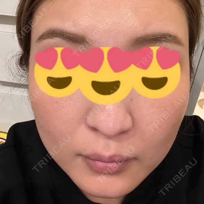 ダーマペン 聖心美容クリニック 大宮院 AFTER メイン用