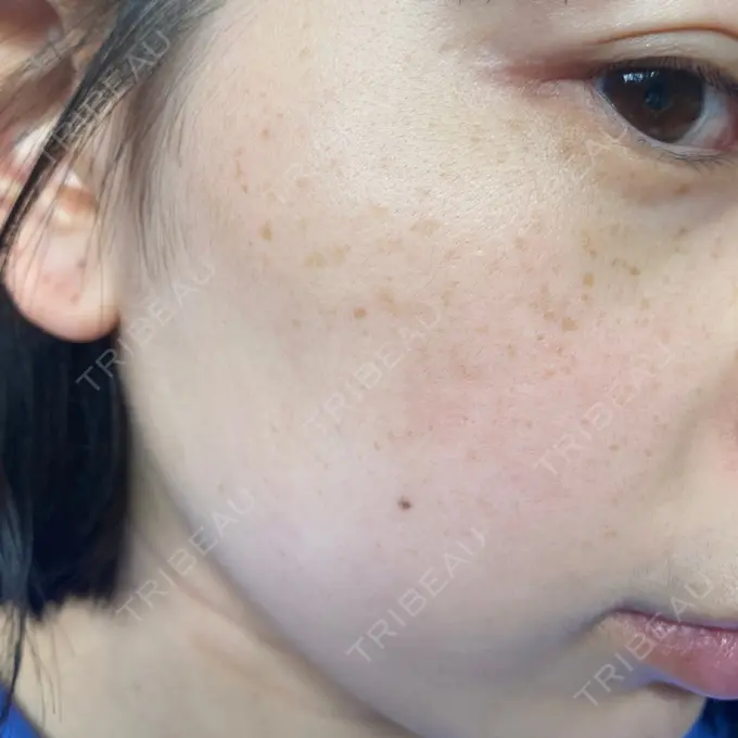 ピコレーザートーニング（美白・肝斑） まゆりなclinic 名古屋栄 AFTER メイン用