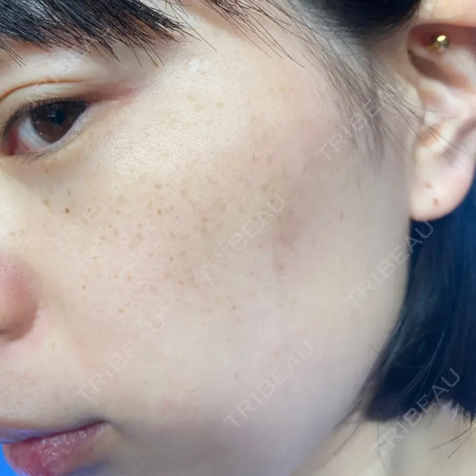 ピコレーザートーニング（美白・肝斑） まゆりなclinic 名古屋栄 DAY 6 メイン用