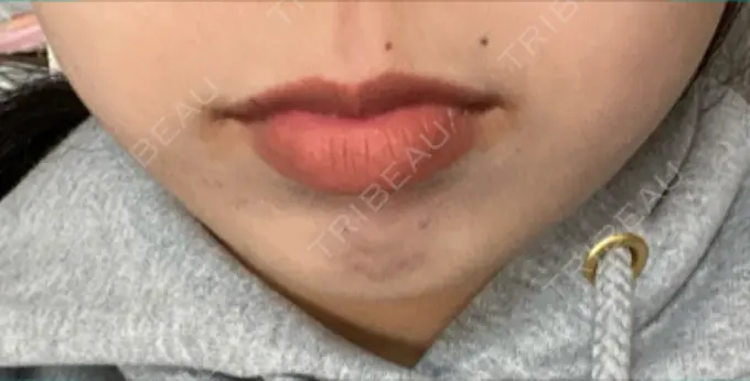 ボトックス（口角） Olino美容外科・美容皮膚科 DAY 2 メイン用