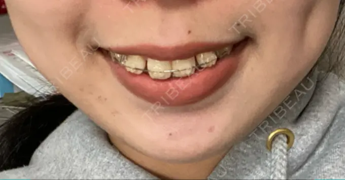 ボトックス（口角） Olino美容外科・美容皮膚科 DAY 2 メイン用