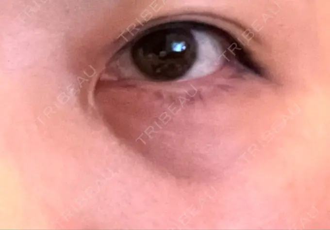 ヒアルロン酸注入（涙袋） / ボトックス（眉間） TCB東京中央美容外科 心斎橋院 DAY 383 メイン用