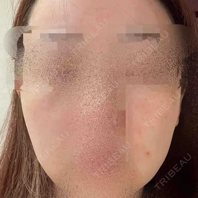 ヴェルヴェットスキン アリエル美容クリニック 大宮院 DAY 94 メイン用