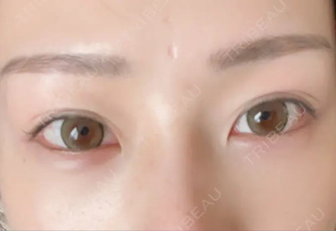 ヒアルロン酸注入（涙袋） / ボトックス（眉間） TCB東京中央美容外科 宇都宮院 AFTER メイン用